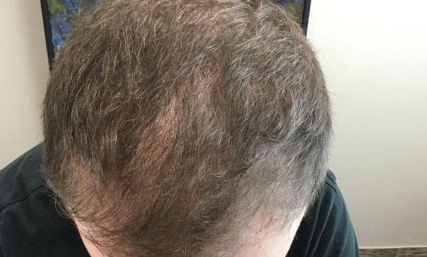 Hairloss before and after