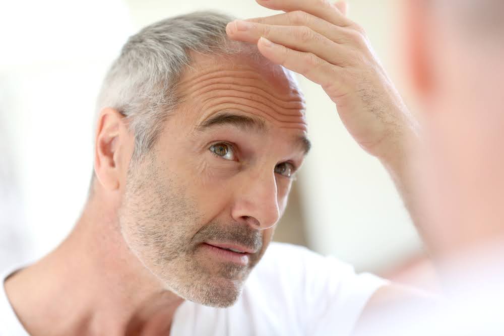Man inspecting his head for hair loss.